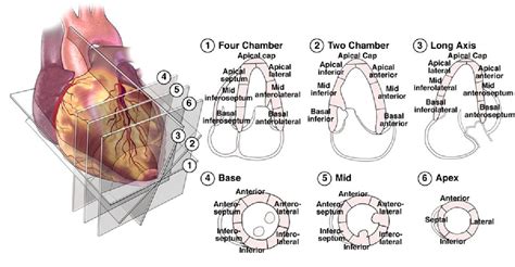 lv wall motion|wall motion abnormalities echo.